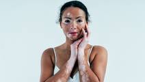 Vitiligo