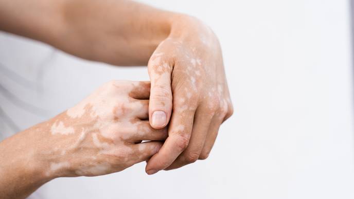 vitiligo