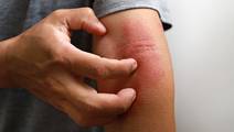 Atopic Dermatitis