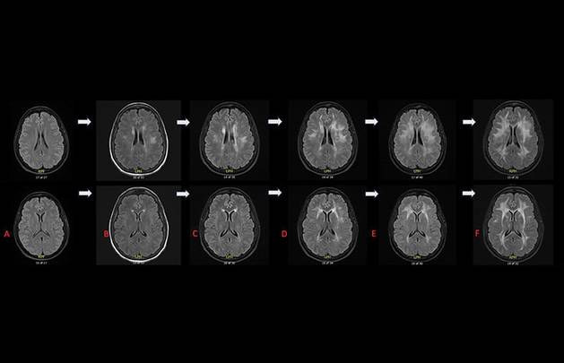 An Unusual Case of Adult Onset Rapidly Progressive Leukoencephalopathy Associated With POLR3B Related Sequence Variati