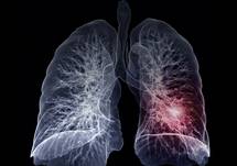 Keys to Overcoming Diagnostic Delays in NTM Lung Disease