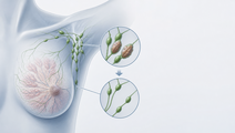 surgical outcomes after neoadjuvant pembrolizumab in keynote 522