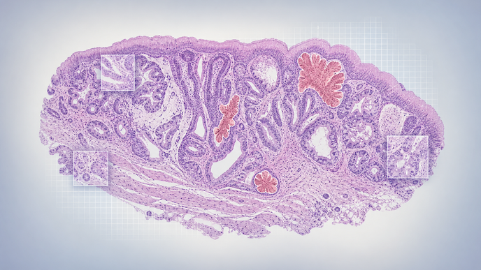 external validation of deep learning for dysplastic barretts esophagus