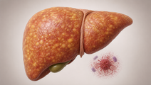 Steatotic Liver Disease Subtypes Linked to Sepsis Risk