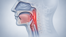 long term effects of multifaceted stewardship for sore throat in primary care