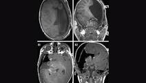 Epilepsy Essentials Hemispherectomy for Early Onset Pediatric Epilepsy A Big Surgery for Small People