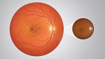 Stylized retina and macula showing age related macular degeneration lesions