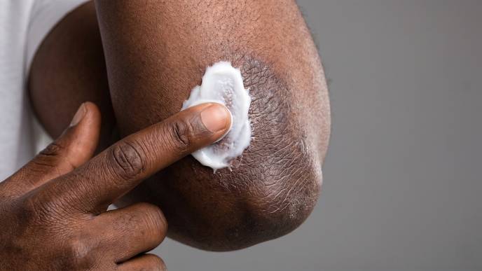 topical corticosteroids