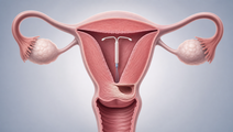 lng ius outperformed hysteroscopic niche resection at 3 years