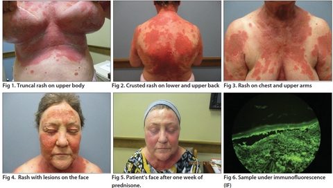 Hailey-Hailey Disease and Pemphigus Foliaceus; Preview: Practice PATH ...