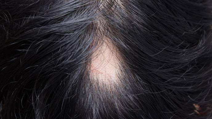 alopecia