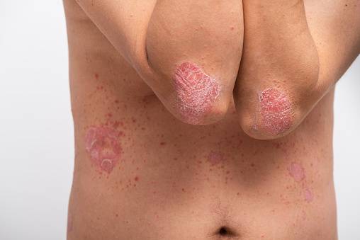Psoriasis