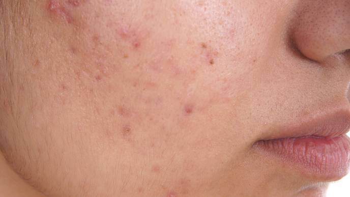 acne