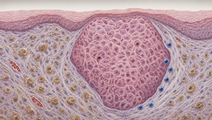 Fn Associated ESCC Resistance Tied to SPP1 Macrophages
