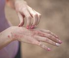 Psoriasis