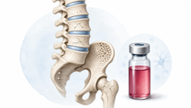 Vitamin B12 Deficiency Linked to Higher Fracture Hazard