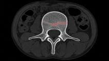 ai fracture detection on ct review finds moderate to good accuracy