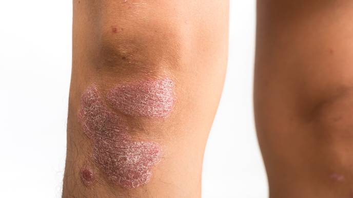 psoriasis