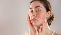 girl w rosacea