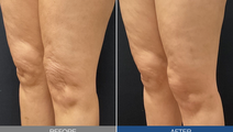 sofwave study results