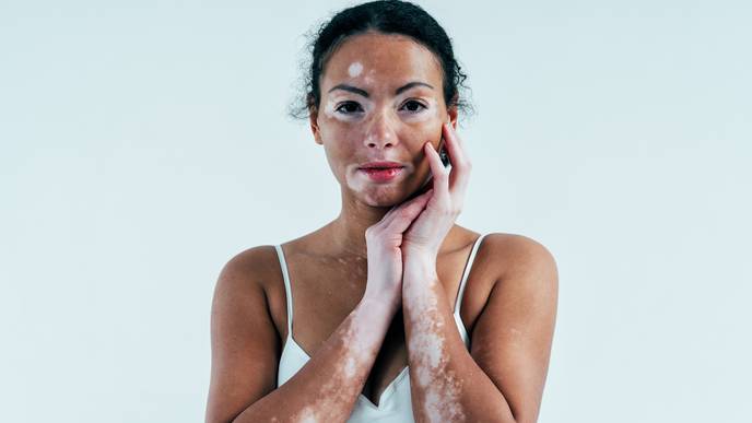 Vitiligo