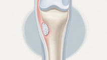 SOLARIO Short Antibiotics Noninferior After Orthopedic Infection