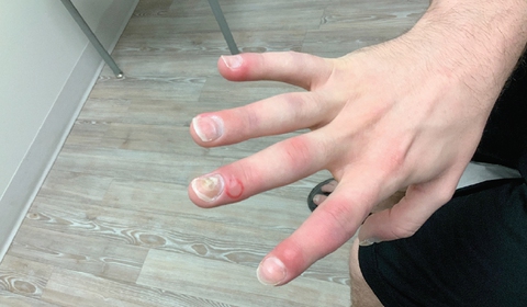 Optimizing Skin Exams with a Next-Gen Wireless Handheld Dermoscopy ...