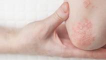 psoriasis