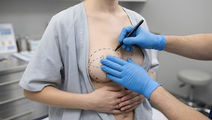 Breast Augmentation