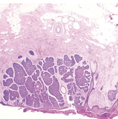 Cutaneous Signet Ring Squamous Cell Carcinoma: Case Presentation and ...