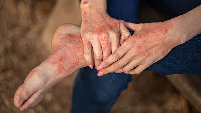 Psoriasis