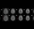 An Unusual Case of Adult Onset Rapidly Progressive Leukoencephalopathy Associated With POLR3B Related Sequence Variati