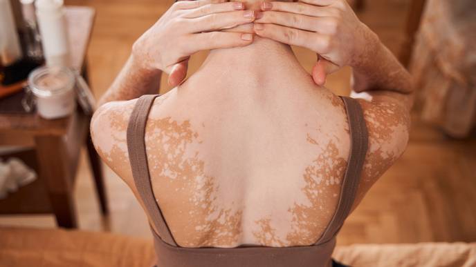 vitiligo