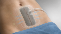 pNPWT Cuts SSI After High Risk Open Abdominal Surgery