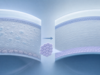 escalon trial tests corneal endothelial cell therapy for corneal edema