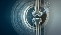 Bone Mineral Density and Mortality Rethinking Prognosis in Osteoarthritis Care