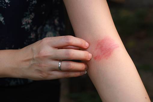 Atopic Dermatitis