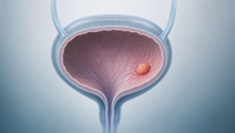 perioperative enfortumab vedotin plus pembrolizumab in bladder cancer