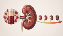 BMI and Hematocrit Predict ESRD Risk in Type 2 Diabetes