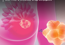 Improving HR Positive HER2 Negative Breast Cancer Outcomes with TROP2 Antibody Drug Conjugates