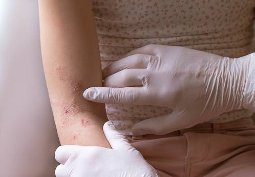 Pediatric Atopic Dermatitis