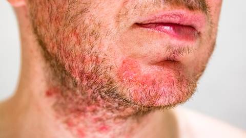 facial eczema
