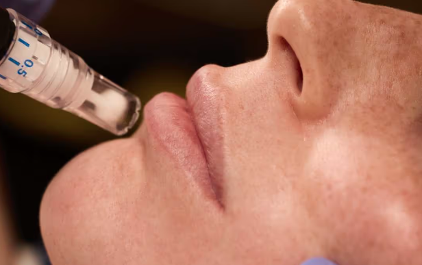SkinPen