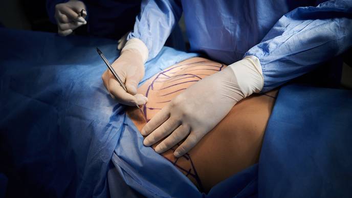 abdominoplasty