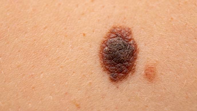 nevus