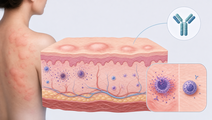 Simplified skin cross section showing chronic spontaneous urticaria inflammation and biologic treatment context