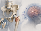 Hip fracture anatomy with brain cue representing postoperative delirium risk after sedation