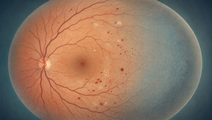 Illustrated retina with peripheral capillary nonperfusion in diabetic retinopathy visible across a broad imaging field
