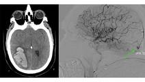 Spontaneous Intracranial Hemorrhage Secondary to Rare Pial Arteriovenous Fistula Rupture