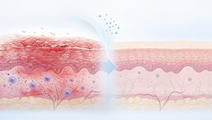 Dupilumab Linked to Early Symptom Relief in Atopic Dermatitis